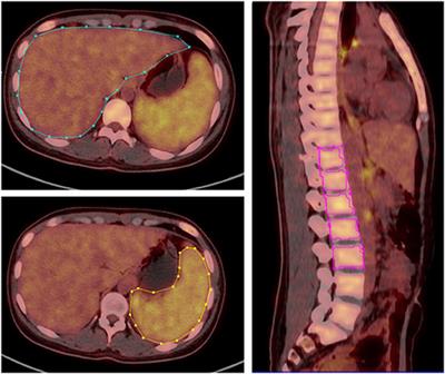 18F-FDG PET/CT Associates With Disease Activity and Clinical Recurrence of AOSD Patients